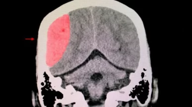 What Are 3 Symptoms of a Brain Injury?