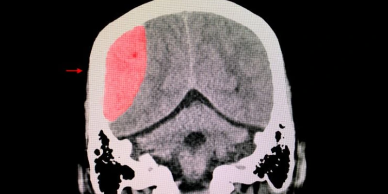 What Are 3 Symptoms of a Brain Injury?